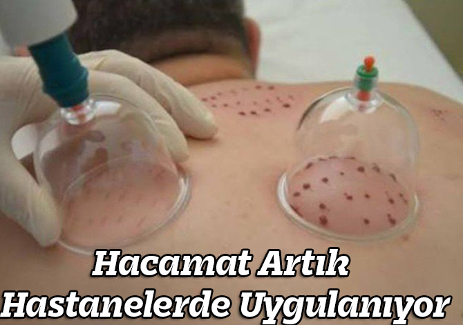 Hacamat Artık Hastanelerde Uygulanıyor