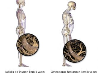 Kemik erimesinden korunmak için ne yapmalı ?